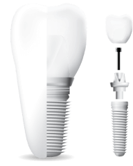 A graphic showing a dental implant.