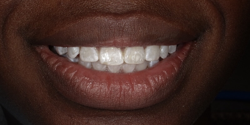 After picture of a patient's teeth.