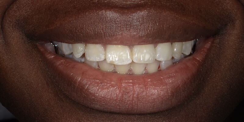Before picture of a patient's teeth.