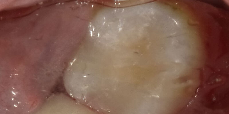 A tooth-colored filling in a patient's mouth.