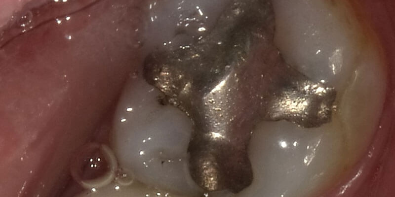 An up-close of a silver amalgam filling in a patient's mouth.