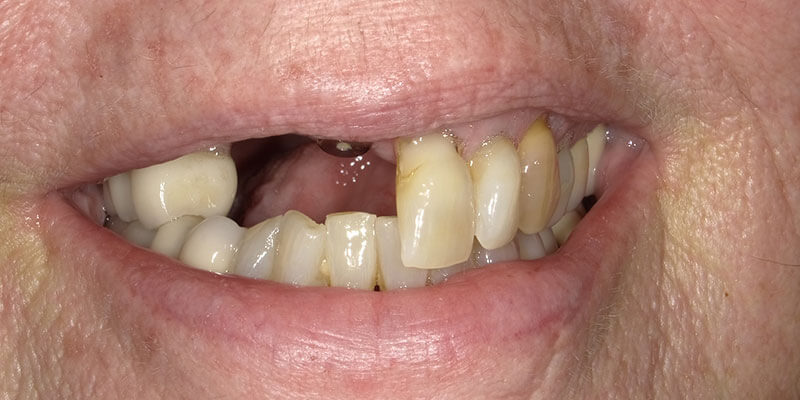 before picture of a patient with missing and crooked teeth.