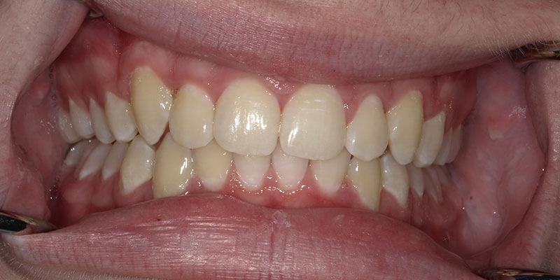 Invisalign after photo of straight teeth.