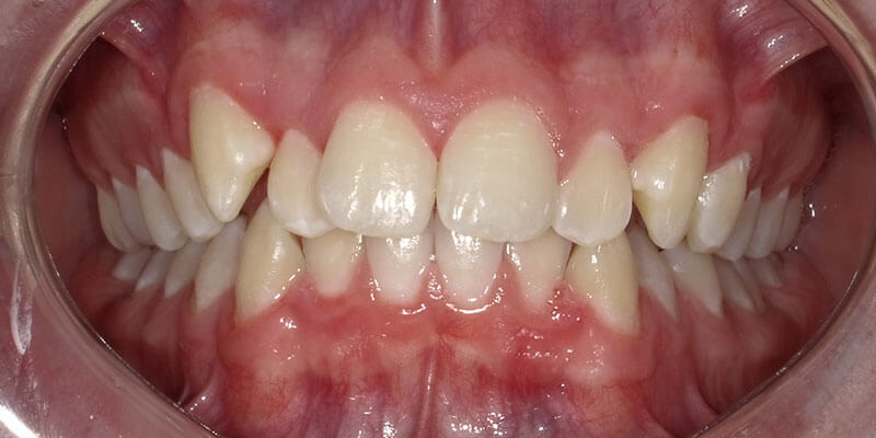 Patient's crooked teeth before Invisalign treatment.