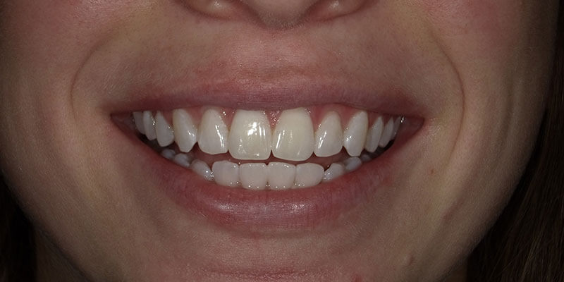 Zoom Whitening after photo.
