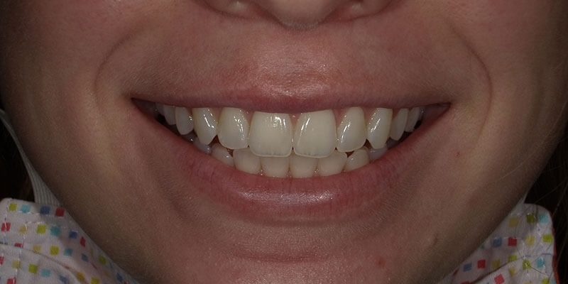 Before Zoom Teeth Whitening.