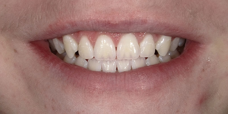 After picture of a patient's white smile after Zoom whitening.