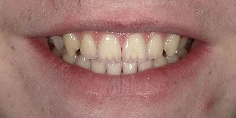 Before picture of a patient's white smile after Zoom whitening.