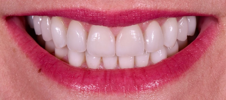 after photo - straight, white teeth.