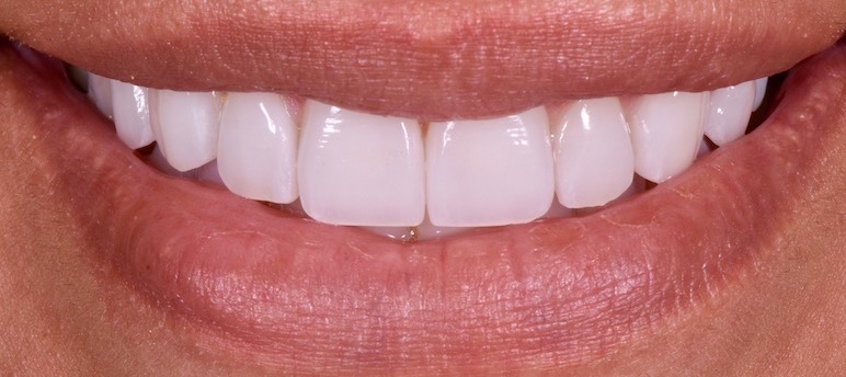 after photo - white, straight, perfectly shaped teeth.