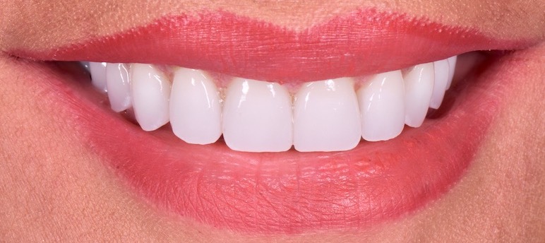 after photo - straight, close teeth.