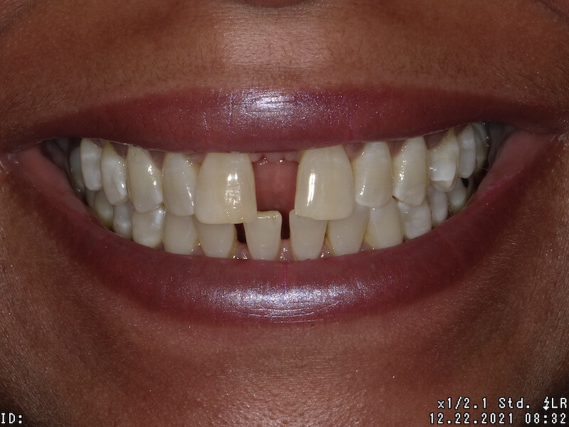 Before photo - front teeth.