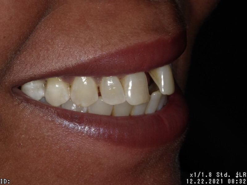 Before photo - gapped smile.