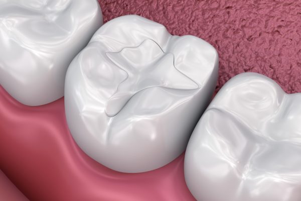 tooth-colored filling at Premier Novi Dentistry